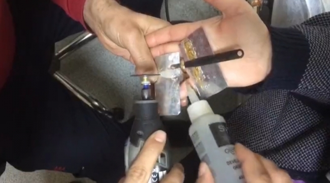 Şanlıurfa'da başarılı yüzük çıkarma operasyonu