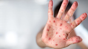 Bakan Memişoğlu'ndan maymun çiçeği açıklaması