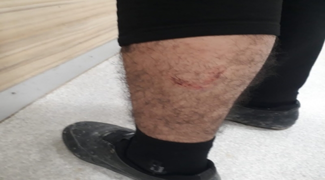 Suruç'ta İşe Giden Bir Kişi Köpeklerin Saldırısına Uğradı