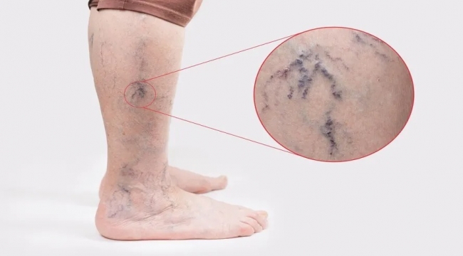 Şanlıurfa'da Varis Tedavisinde Modern Yöntemler