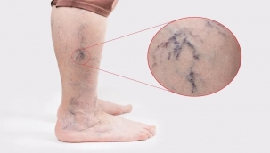 Şanlıurfa'da Varis Tedavisinde Modern Yöntemler