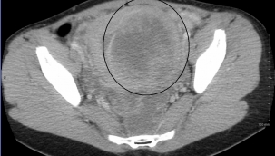 Şanlıurfa'da Ameliyatsız Yöntemle Kadınlara Umut: Pelvik Konjesyon Tedavisi