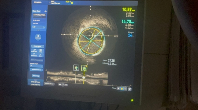Şanlıurfa'da Kardiyoloji Alanında Bir İlk: IVUS Yöntemi ile Stent Uygulaması