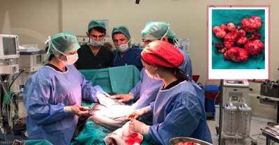 Karın Ağrısıyla Geldi, Rahminden 50 Ur Çıkartıldı