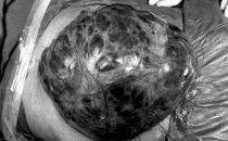 Kilo aldığını sandı böbreğinden futbol topu büyüklüğünde tümör çıktı