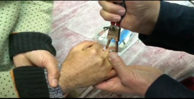 Sıkışan Yüzük, İtfaiye Ekipleri Tarafından Kesilerek Çıkartıldı