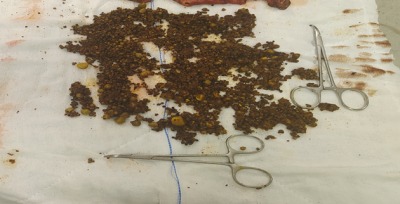 Urfa'da 70 yaşındaki hasta başarılı operasyon ile sağlığına kavuştu