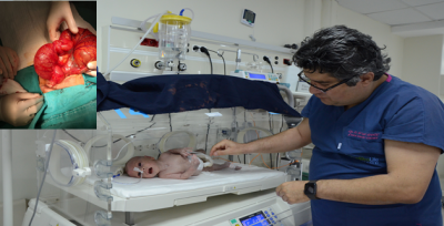 Yeni Doğan Bebekte 40 Santim Kitle Çıkartıldı